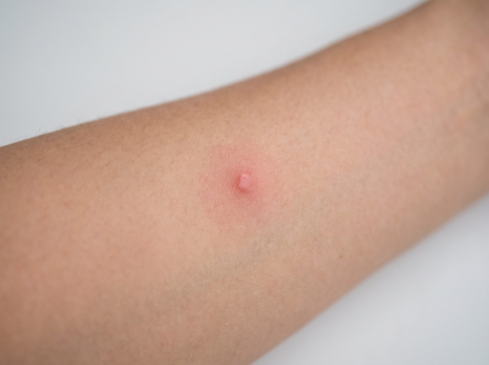 Close-up photograph of a fresh red wolf spider bite mark on skin showing two faint puncture points and mild swelling